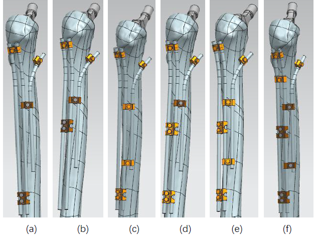 Optimal configuration of a three-rod ortho-bridge system in the treatment of Vancouver type B1 periprosthetic femoral fractures: A finite element analysis