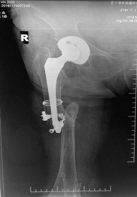 A Case Study of Periprosthetic Femur Fracture and Internal Fixation
