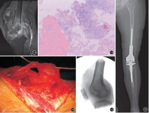 Malignant Tumor in Knee Joint Cavity Extra-Articular Resection: Clinical Observation of 4 Cases Series
