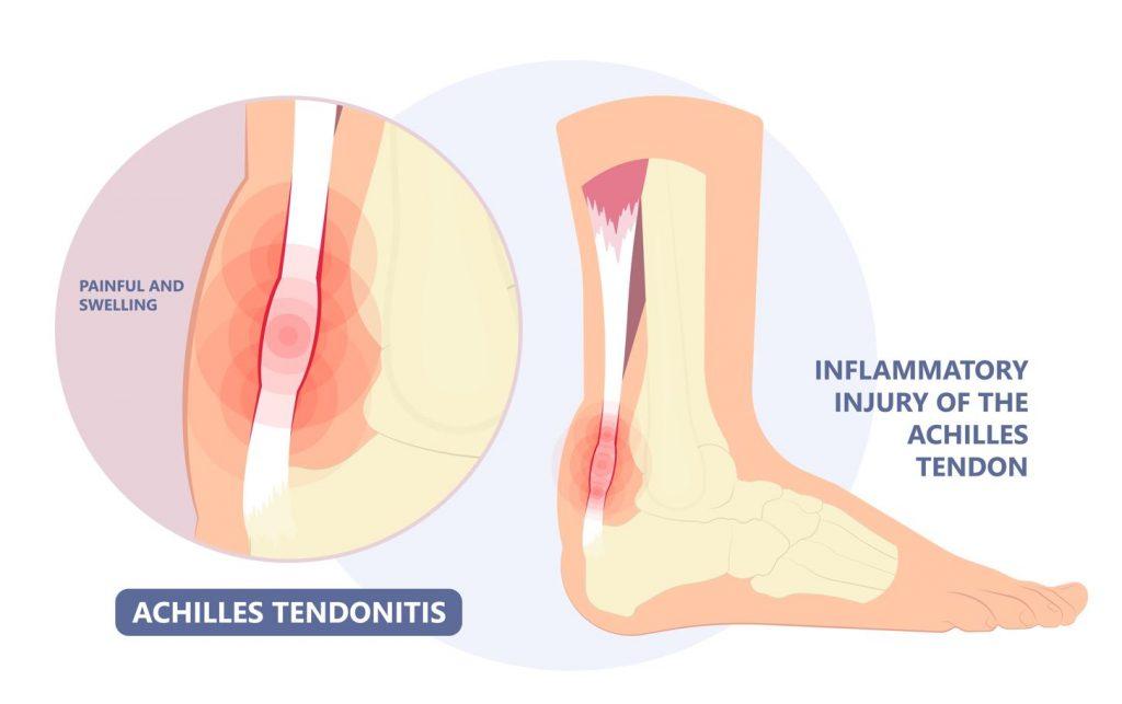 Achilles Tendinitis